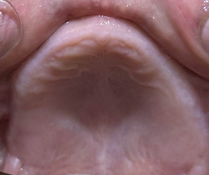하양임플란트, 비용 걱정이 컸던 60대 후반 남성의 18개 수술 사례 6 image 1