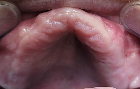 경산치과, 타원에서 임플란트가 어렵다고 들었다면 다시 확인해야 할 것 6 image 106