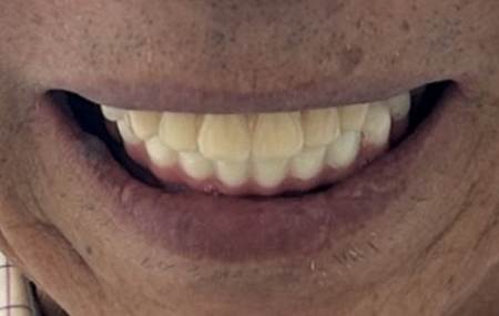 경산치과, 타원에서 임플란트가 어렵다고 들었다면 다시 확인해야 할 것 18 image 110