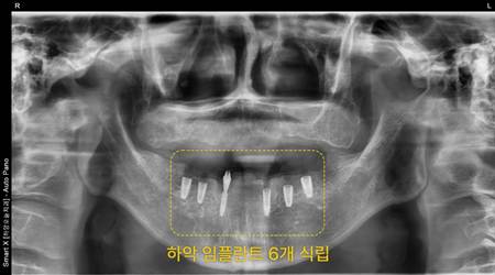 경산치과, 타원에서 임플란트가 어렵다고 들었다면 다시 확인해야 할 것 14 image 111