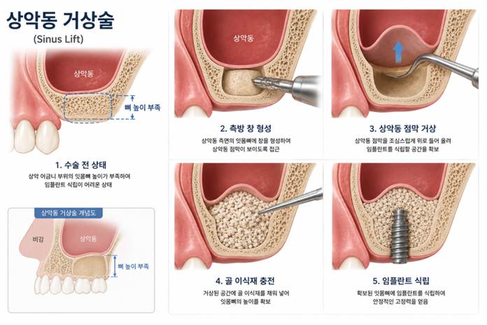 시지치과 임플란트 뼈이식 과잉진료인지 아닌지 구분하는 방법 7 image 122