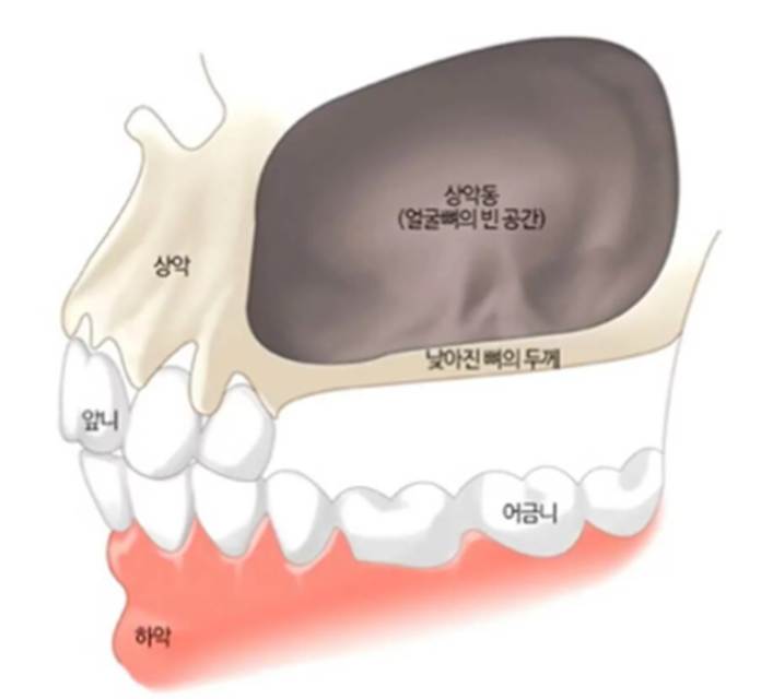 경산치과추천 발치 후 방치했다가 임플란트 3개 더 심게 된 이유 6 image 125