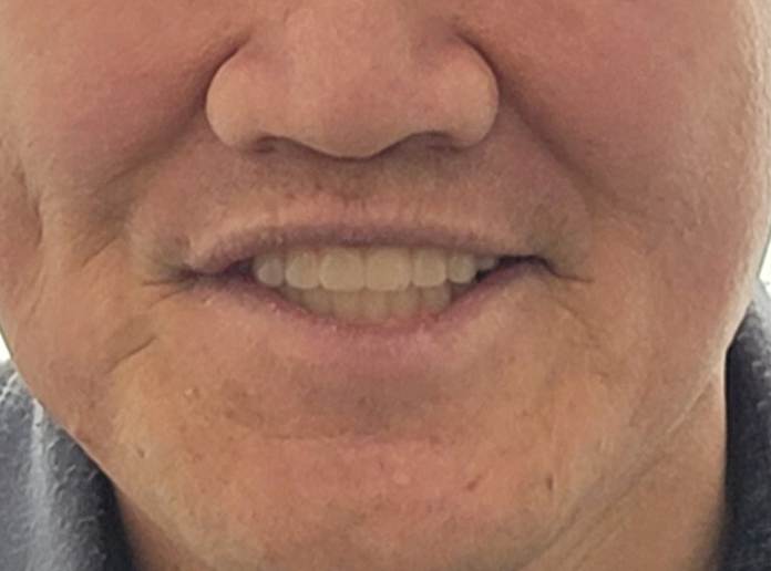 하양임플란트, 비용 걱정이 컸던 60대 후반 남성의 18개 수술 사례 21 image 13