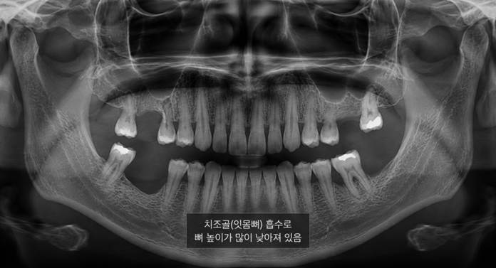 하양치과, 임플란트가 무서워서 미룬다면 네비게이션 임플란트를 확인하세요. 4 image 136