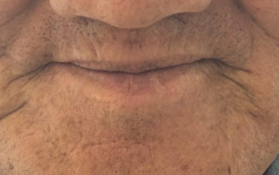 하양임플란트, 비용 걱정이 컸던 60대 후반 남성의 18개 수술 사례 8 image 3
