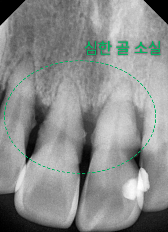 경산임플란트, 치과 공포심으로 20년 미뤘던 50대 남성의 6개 수술 사례 5 image 3