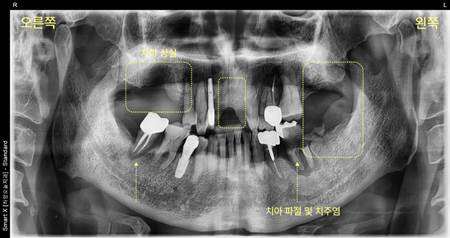 하양읍치과 공포 이겨내고 임플란트 15개 수술한 사례 4 image 41