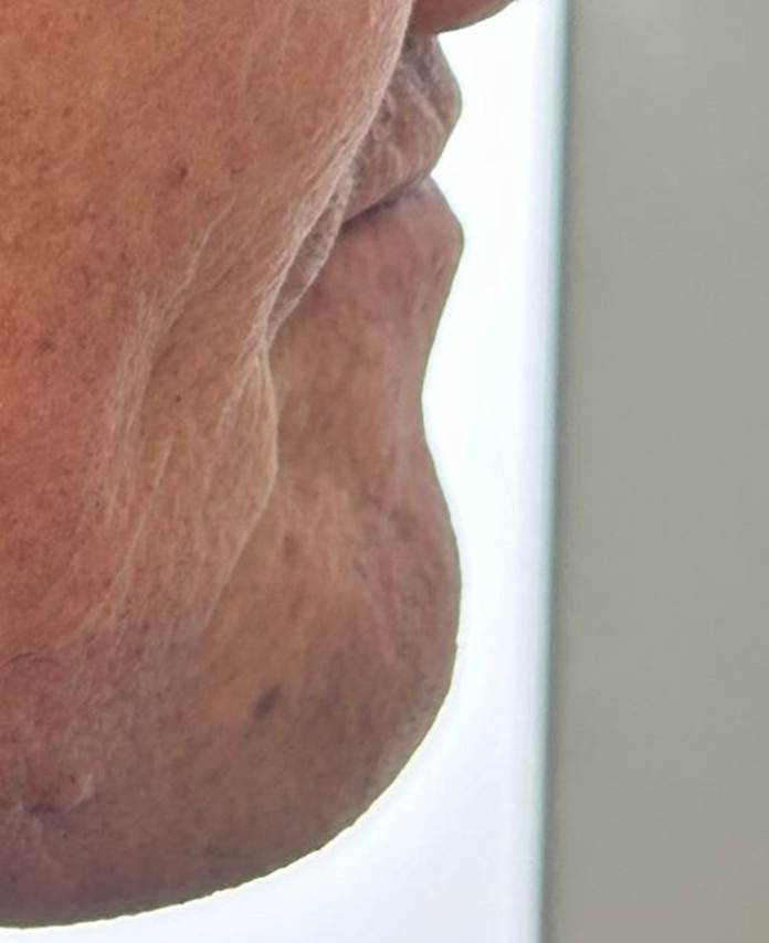 하양임플란트, 비용 걱정이 컸던 60대 후반 남성의 18개 수술 사례 9 image 5
