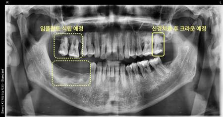 경산치과 당뇨 있다면 스트라우만 임플란트 해야 하는 이유 5 image 57
