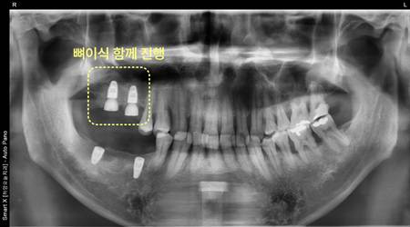 경산치과 당뇨 있다면 스트라우만 임플란트 해야 하는 이유 10 image 58