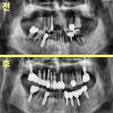 하양읍치과 공포 이겨내고 임플란트 15개 수술한 사례 17 image 58