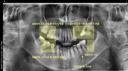 진량치과 공포증 극복 후 임플란트 수술과 앞니 부분교정 사례 4 image 60