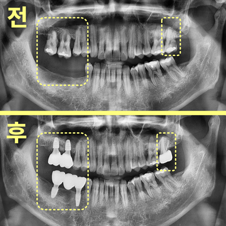 경산치과 당뇨 있다면 스트라우만 임플란트 해야 하는 이유 18 image 60