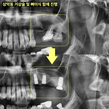 진량치과 공포증 극복 후 임플란트 수술과 앞니 부분교정 사례 6 image 63