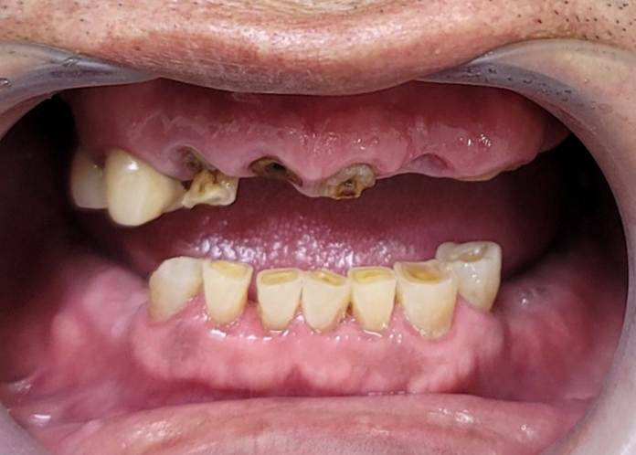 하양치과추천, 암 수술 후 미뤄둔 전악 임플란트 치료를 다시 시작한 사례 4 image 66