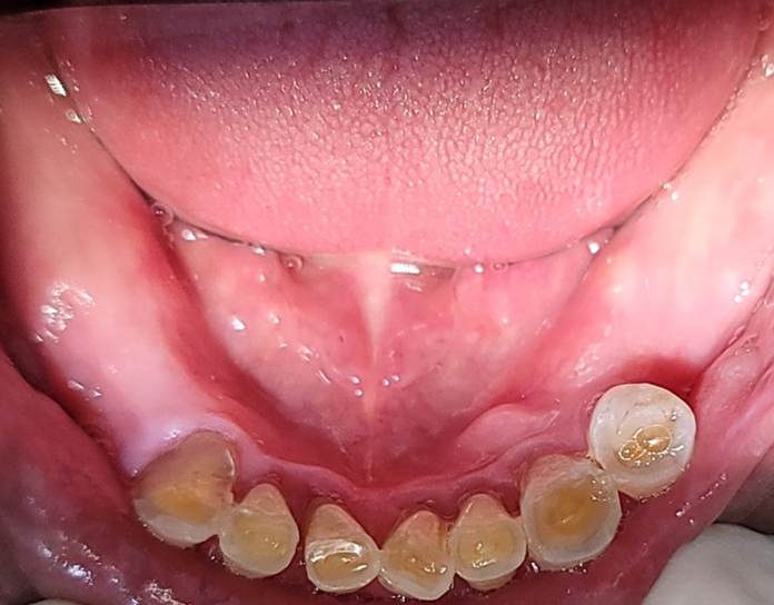 하양치과추천, 암 수술 후 미뤄둔 전악 임플란트 치료를 다시 시작한 사례 6 image 67
