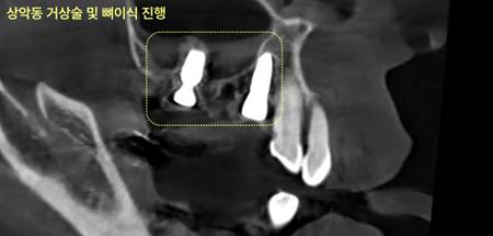 진량치과 공포증 극복 후 임플란트 수술과 앞니 부분교정 사례 11 image 67