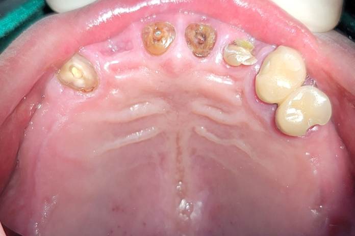 하양치과추천, 암 수술 후 미뤄둔 전악 임플란트 치료를 다시 시작한 사례 5 image 68