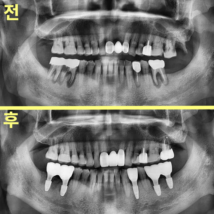 하양임플란트 오래 쓰고 싶다면 재료를 꼭 확인하세요 4 image 77