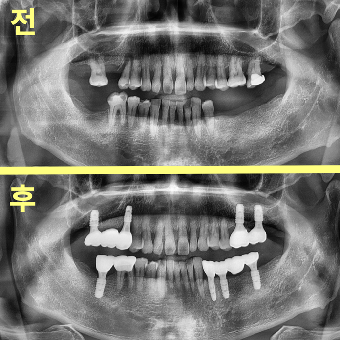 하양치과, 임플란트가 무서워서 미룬다면 네비게이션 임플란트를 확인하세요. 3 image 93