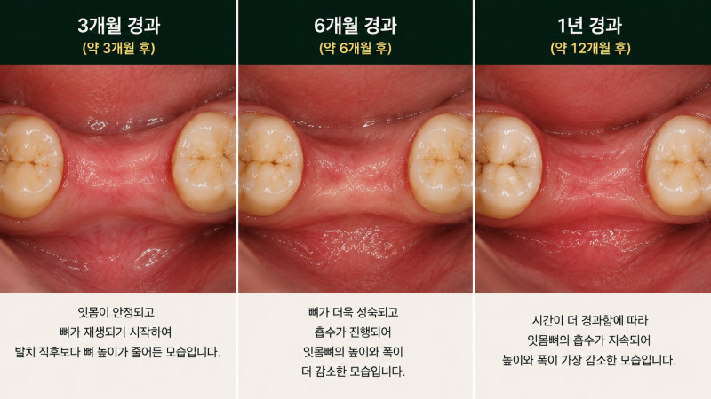 발치 후 잇몸뼈 흡수 경과 사진