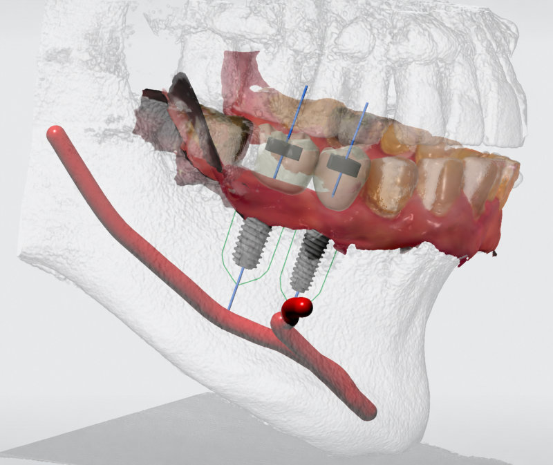 디지털 네비게이션 임플란트, 치과마다 결과가 다른 진짜 이유 11 치아 임플란트와 신경 위치 3D 이미지