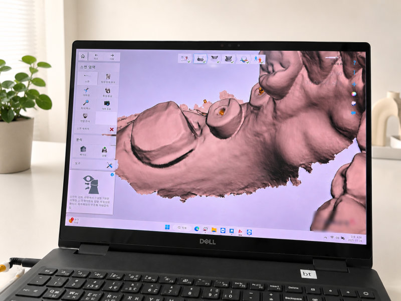 디지털 네비게이션 임플란트, 치과마다 결과가 다른 진짜 이유 4 노트북 화면의 치아 3D 스캔