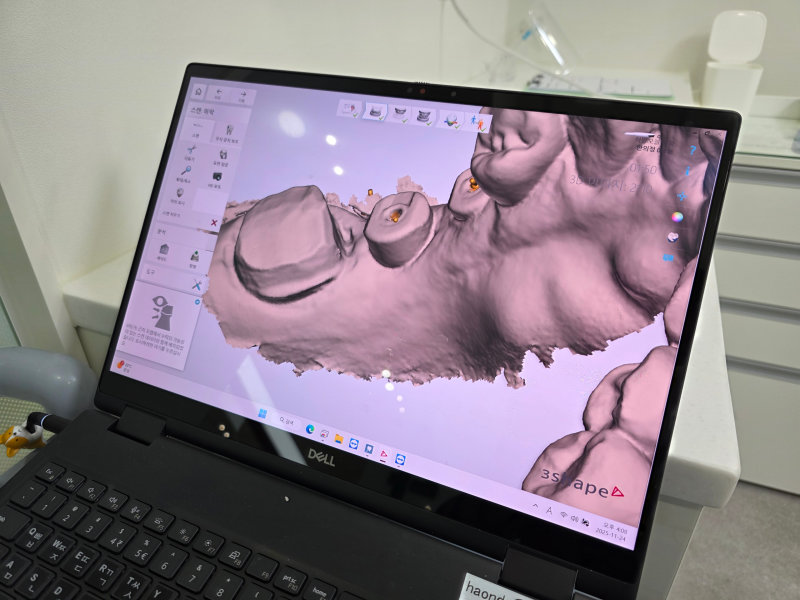 하양주변치과 잇몸에서 피가 나는 이유와 관리법 3 치아 3D 스캔 이미지가 보이는 노트북 화면