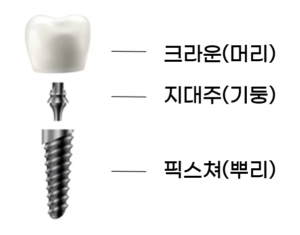 임플란트 보철물의 세 가지 구성 요소인 크라운, 지대주, 픽스처를 분리하여 보여주는 그림