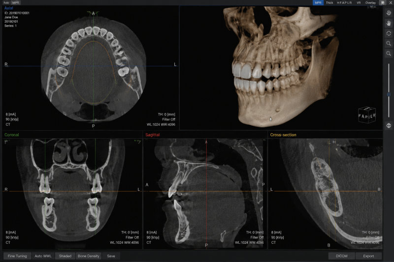 환자의 구강 CT 촬영 이미지. 다양한 각도에서 치아와 턱뼈의 단면 및 3D 이미지를 보여줌