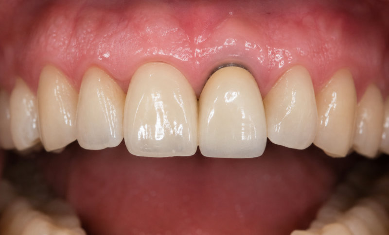 하양치과 임플란트 수술 후 불편함 원인과 해결책 9 환자 앞니 임플란트 보철물 주변 잇몸이 빨갛게 부어있는 모습