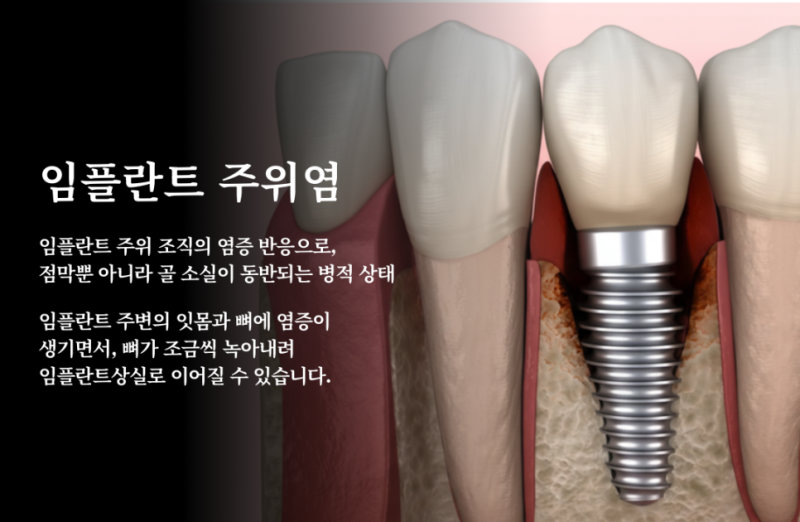 임플란트 잇몸 염증, 괜찮아질까요? 방치하면 안 되는 이유 4 임플란트 주위염 설명 이미지