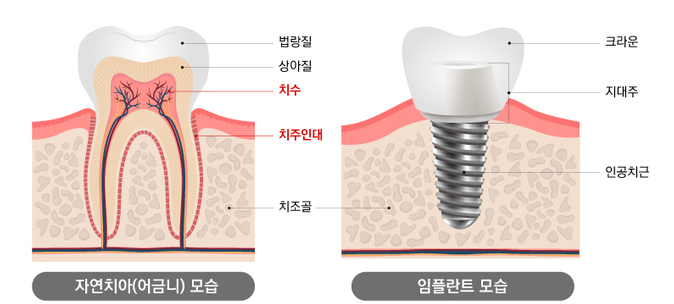 하양치과 전체 임플란트, 모든 치아 발치해야 할까? 4 자연치아와 임플란트의 구조를 비교하는 치과 해부학 일러스트