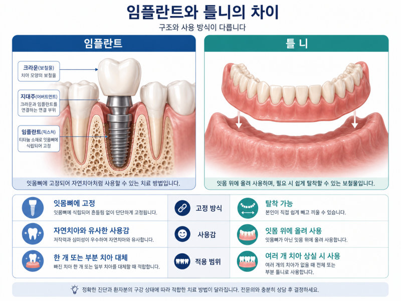 임플란트와 틀니의 차이점 설명