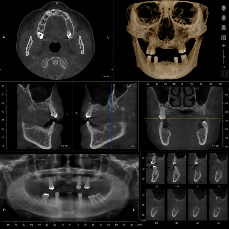 임플란트 시술 전 3D CT 촬영 사진