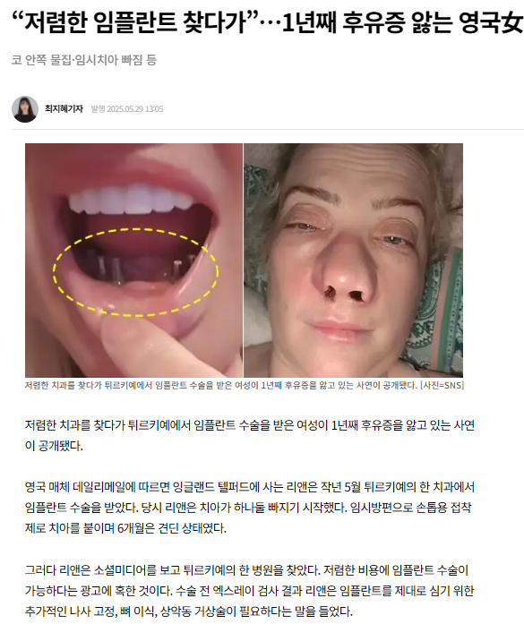 임플란트 후유증을 겪는 여성의 구강 및 얼굴 사진과 관련 기사