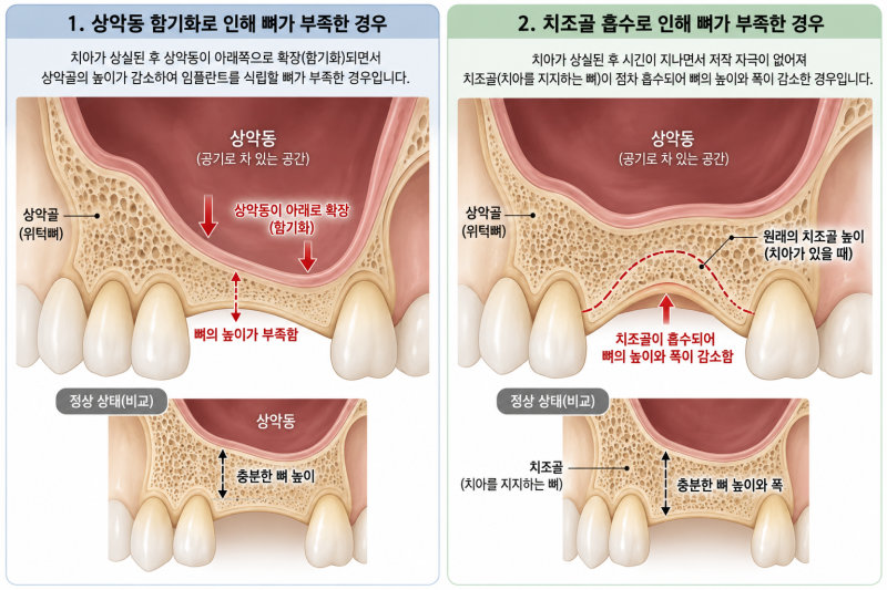 상악동 함기화와 치조골 흡수로 인한 뼈 부족 현상 설명 그림