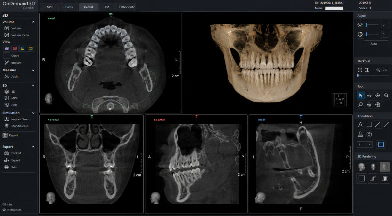 치과용 3D CT 영상 분석 소프트웨어 화면