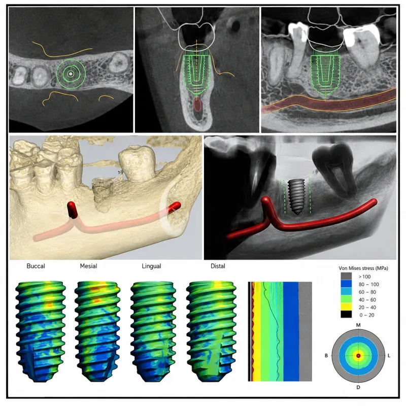 하양치과 원데이 임플란트 가능한 조건 6 임플란트 식립 전후 3D CT 이미지와 임플란트 주변 응력 분석 이미지